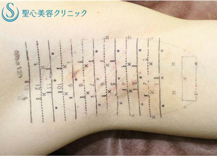 多汗症わきが治療