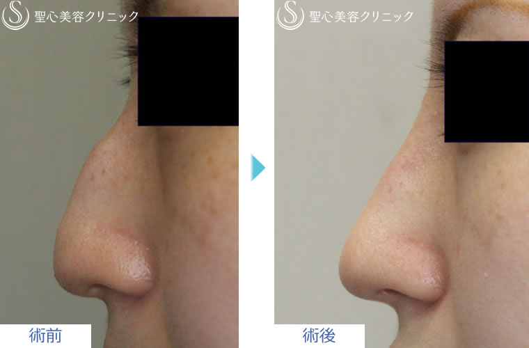 症例写真　術前術後　鼻の整形