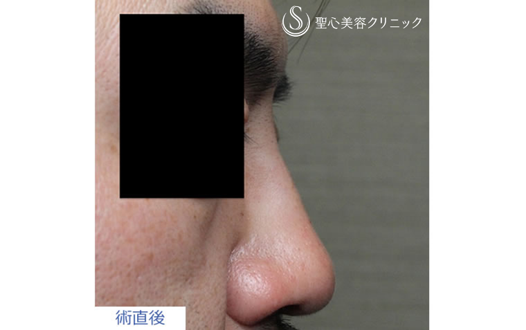 症例写真 術直後 鼻の整形