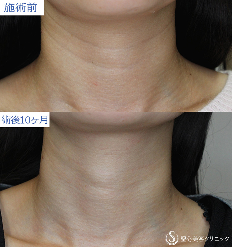 プレミアムPRP皮膚再生療法の症例写真