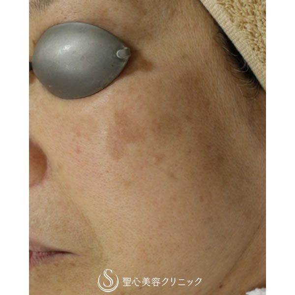 症例写真 術後 美容皮膚科