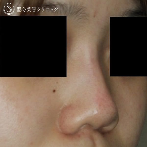 症例写真 術後 鼻の整形