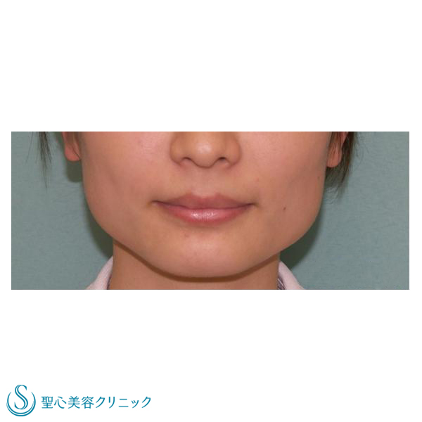 症例写真 術前 小顔に整形