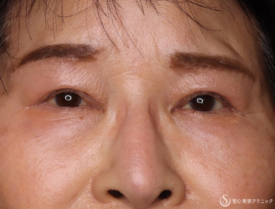 症例写真 術後 眼瞼下垂（切開法/腱膜縫縮法）+眉下切開法