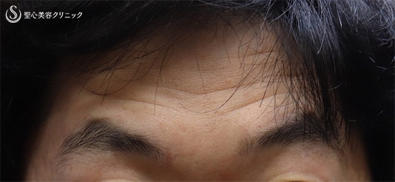 症例写真 術前 プレミアムPRP皮膚再生療法