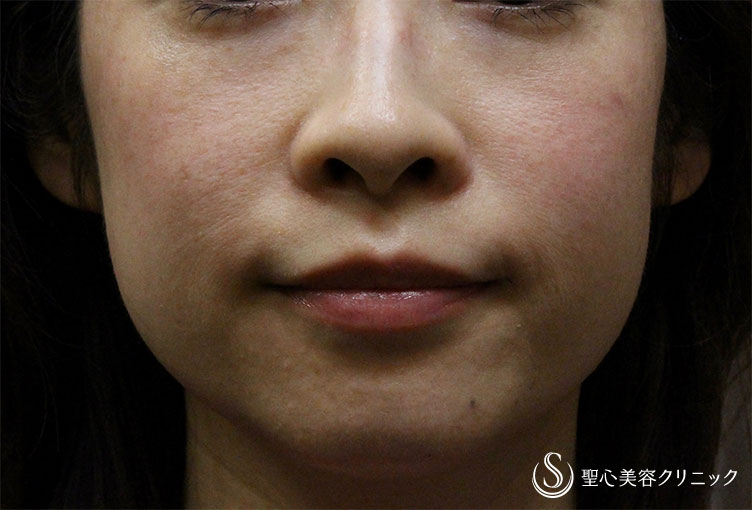症例写真 術前 プレミアムPRP皮膚再生療法＋ウルセラシステム