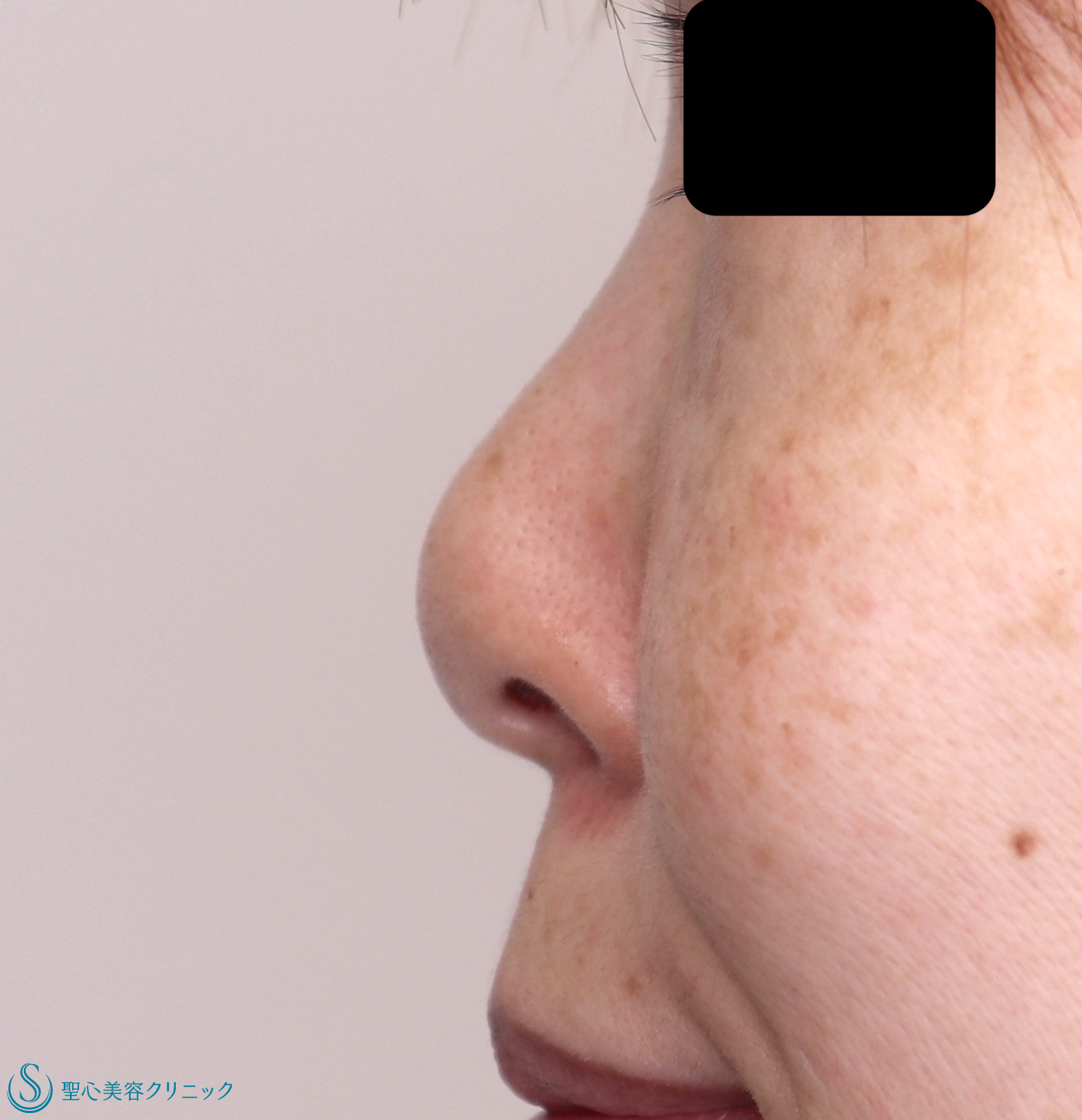 症例写真 術前 鼻尖縮小+鼻尖形成（耳介軟骨移植）+鼻孔縁下降術