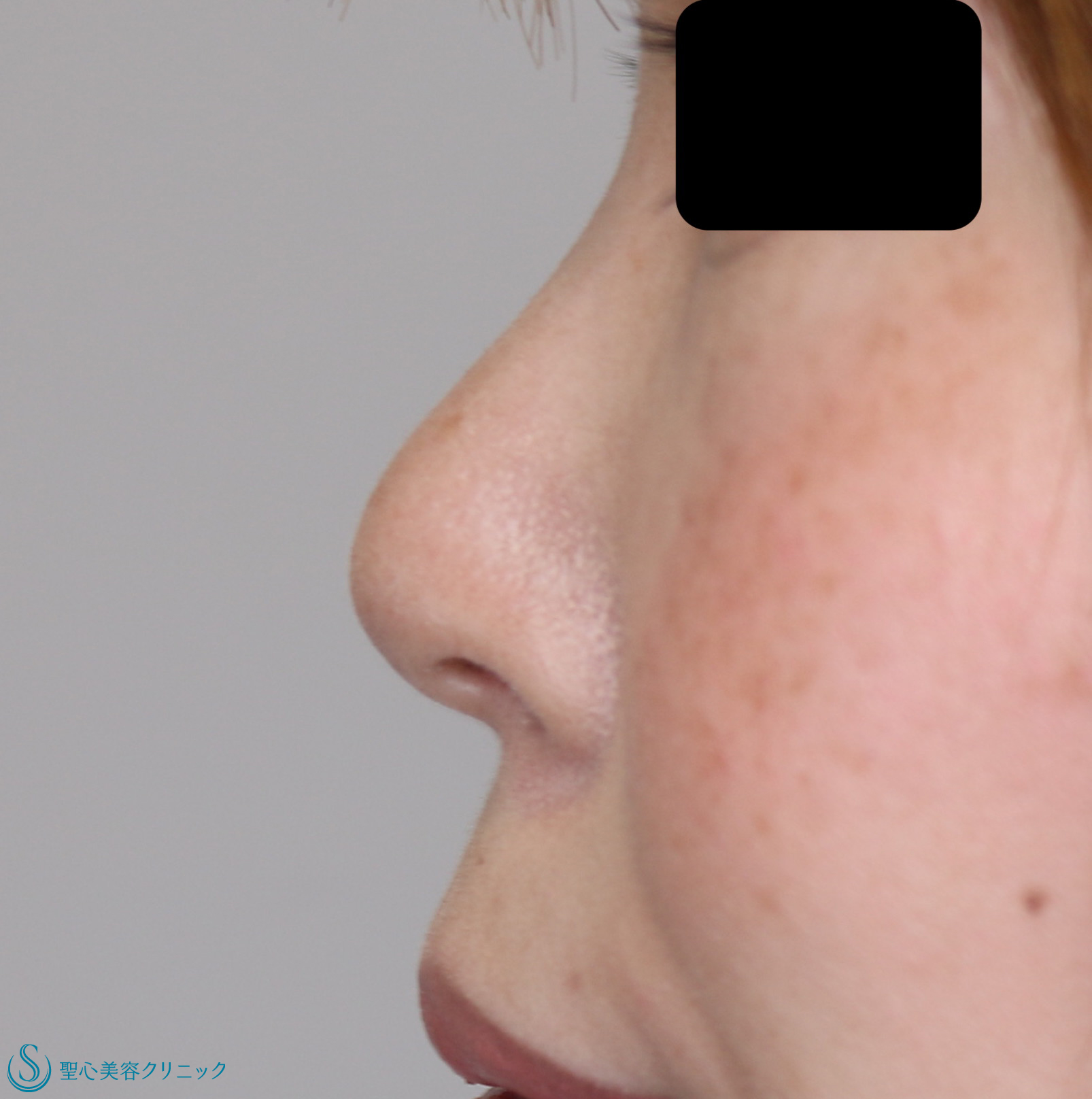 症例写真 術後 鼻尖縮小+鼻尖形成（耳介軟骨移植）+鼻孔縁下降術