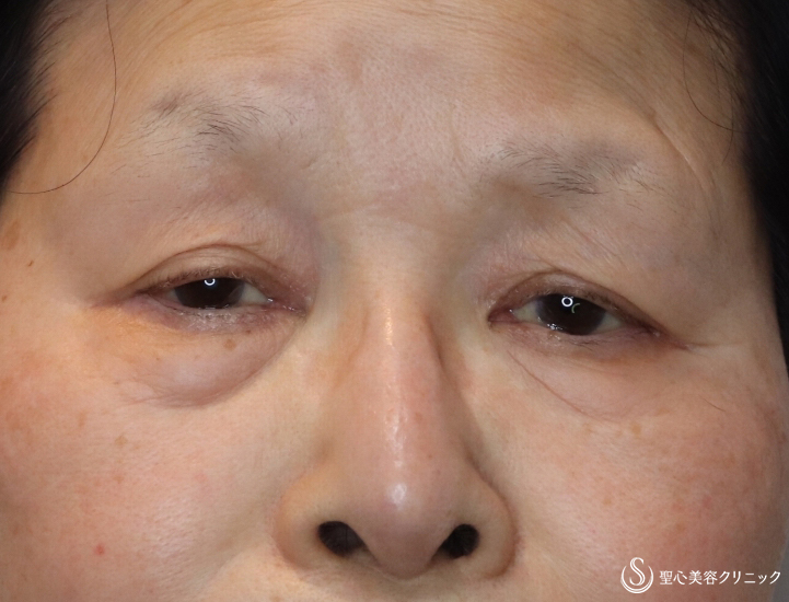 症例写真 術前 眼瞼下垂（切開法/腱膜縫縮法）+眉下切開法