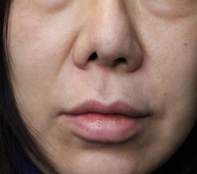 症例写真 術前 鼻孔縁複合組織移植術