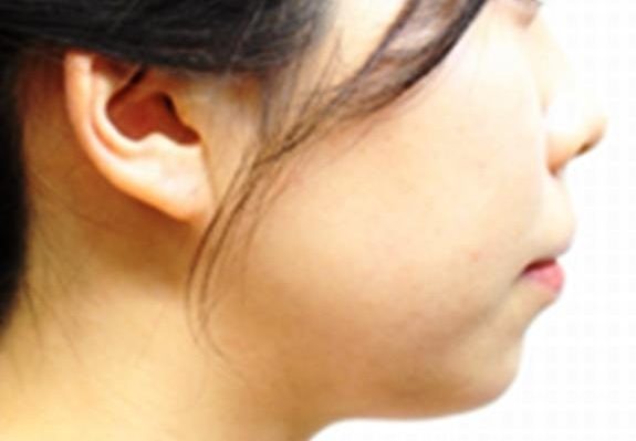 症例写真 術前 プロテーゼによる隆鼻・あご形成術