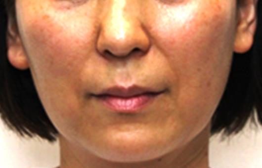 症例写真 術後 プレミアムPRP皮膚再生療法