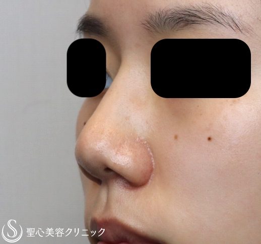 症例写真 術前 鼻プロテーゼ+鼻尖縮小+耳介軟骨移植