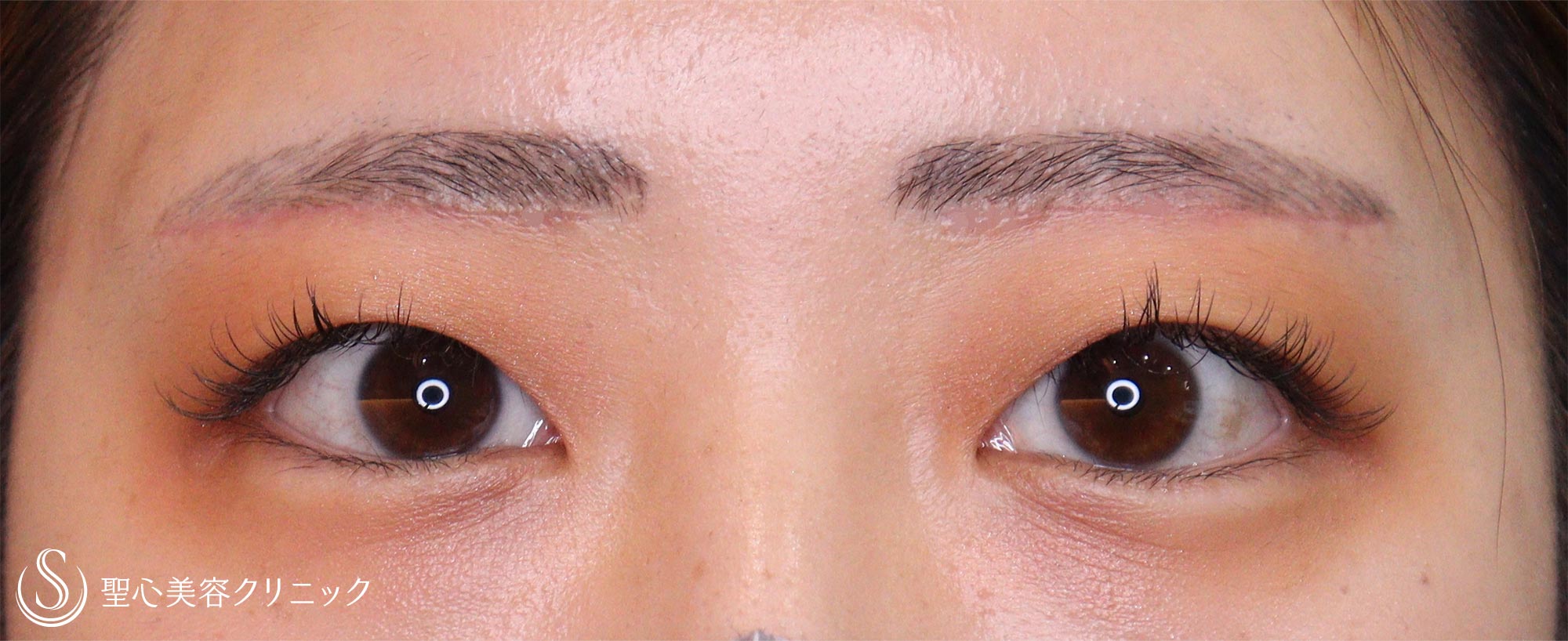 眉下切開_After