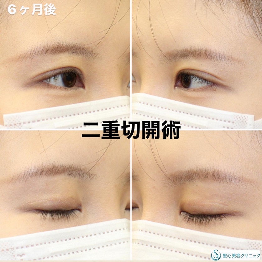 二重術（切開法）部分切開/全切開_After