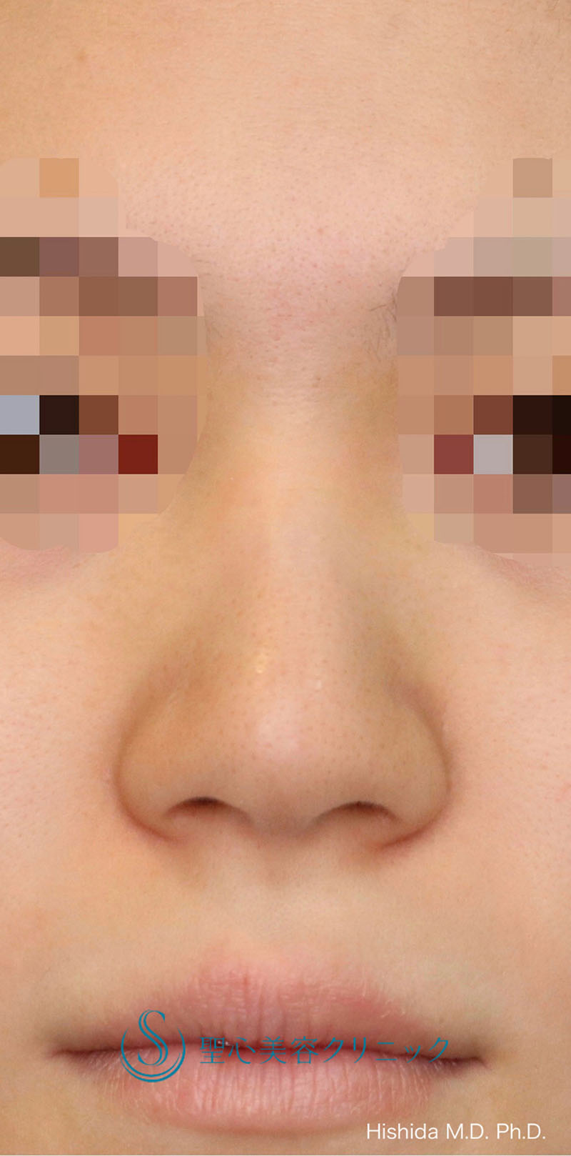 小鼻縮小＋プロテーゼによる隆鼻術＋鼻尖縮小＋鼻尖形成（耳介軟骨移植）_Before