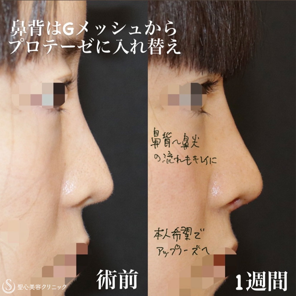 鼻尖縮小＋鼻尖形成（耳介軟骨移植）＋プロテーゼによる隆鼻術＋移植軟骨除去_After