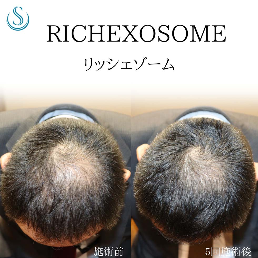 RichExosome（リッシェゾーム）_Before