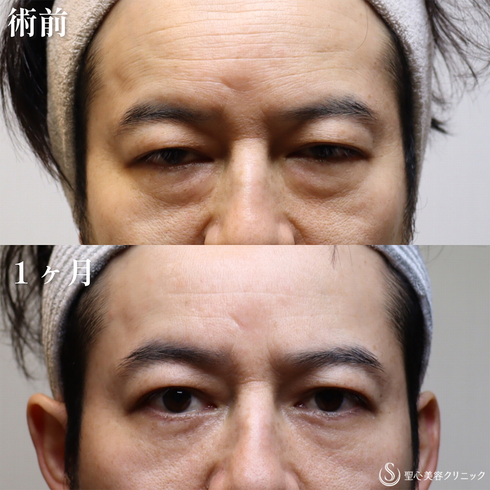 目の下の脂肪取り（経結膜下脱脂法）_Before