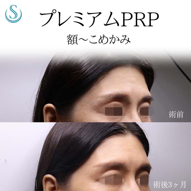 プレミアムPRP皮膚再生療法_Before