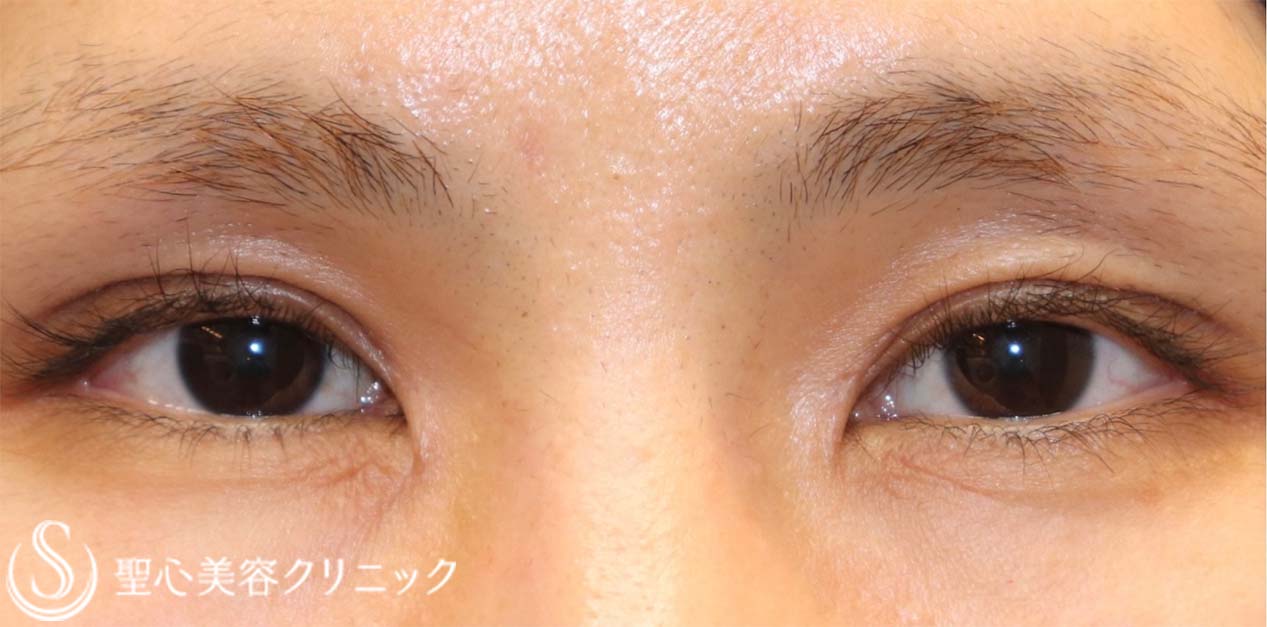 目上切開_After