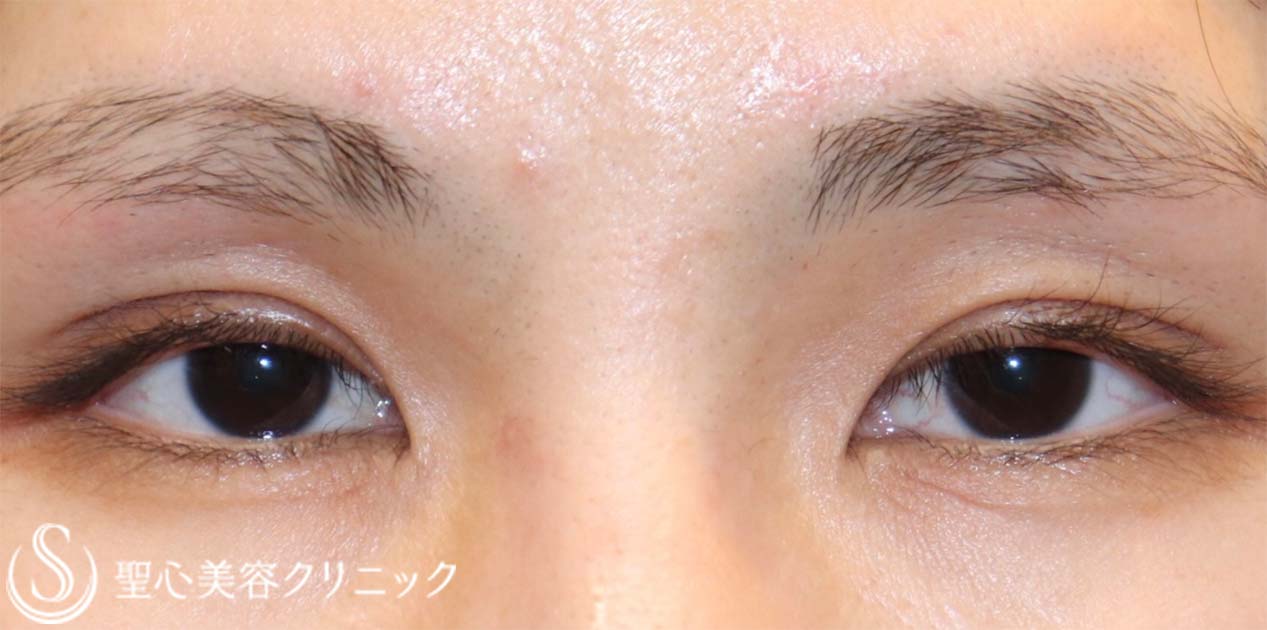 目上切開_Before