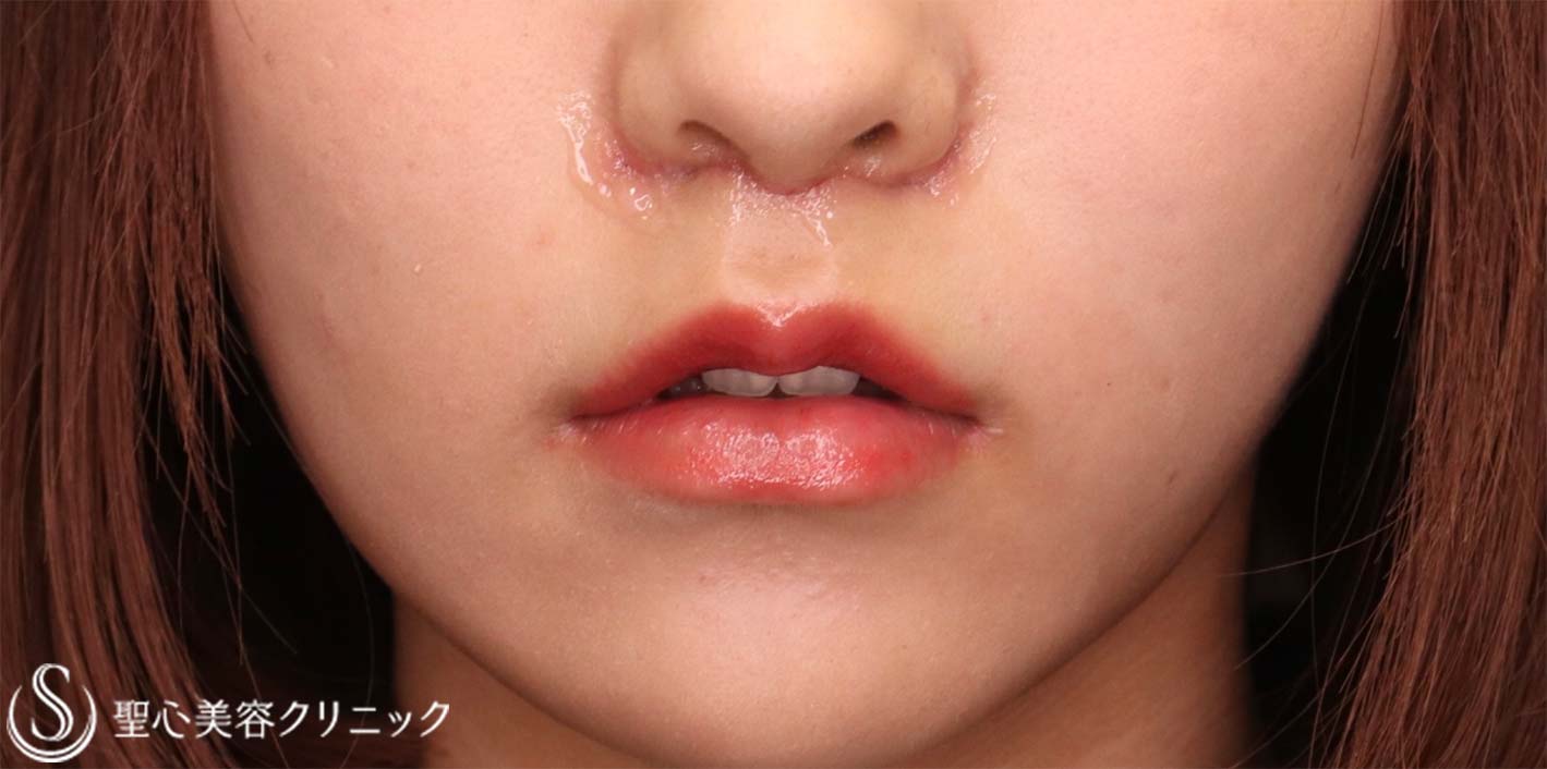 鼻下短縮術（リップリフト/人中短縮）_After