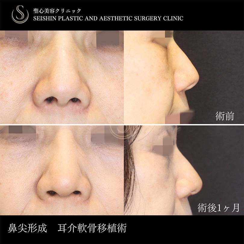 鼻尖形成（耳介軟骨移植）＋鼻尖縮小_After
