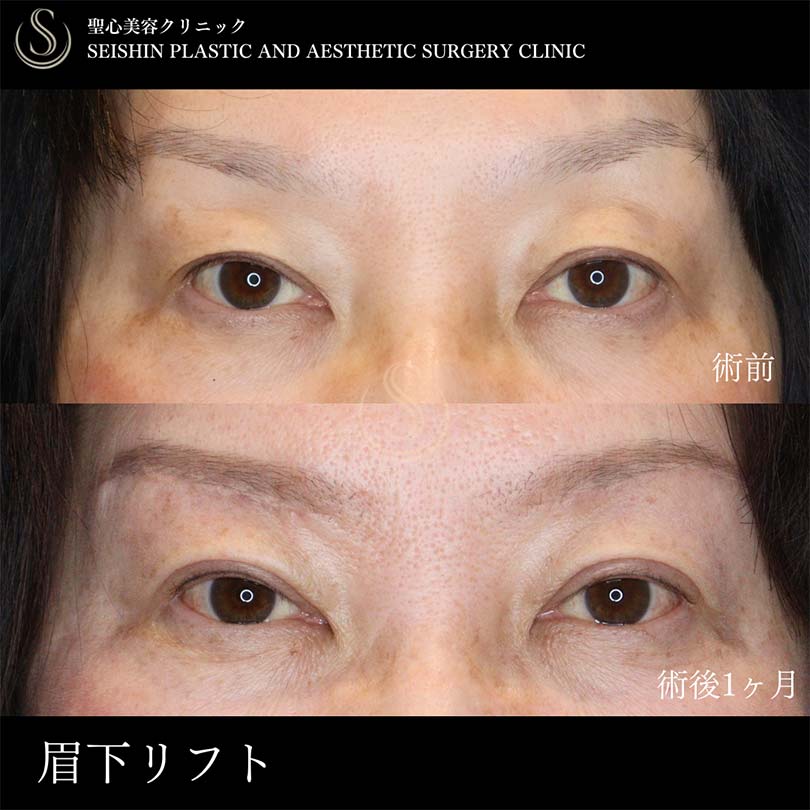 眉下切開法（眉下リフト）_Before