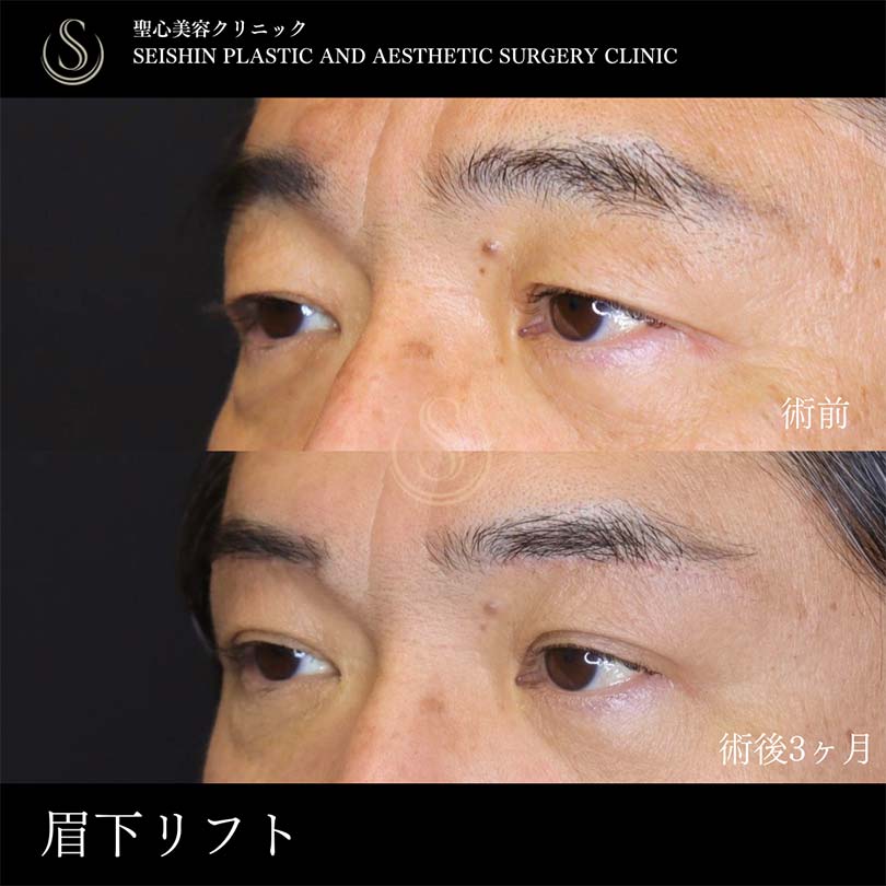 眉下切開法（眉下リフト）_After