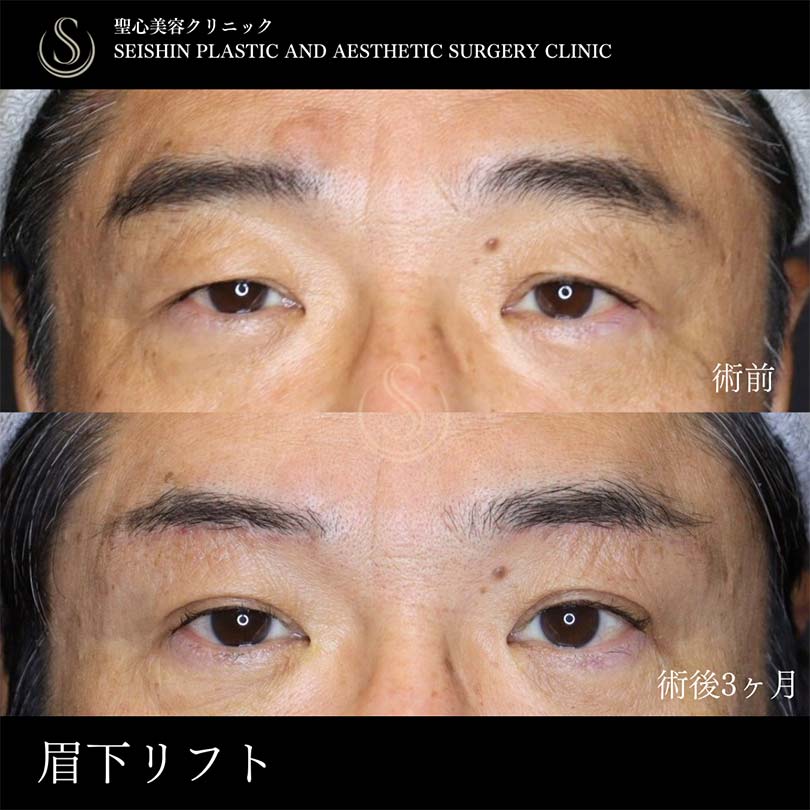 眉下切開法（眉下リフト）_Before