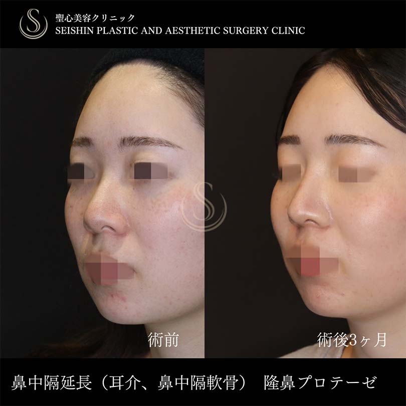 鼻中隔延長術＋プロテーゼによる隆鼻術＋鼻尖形成（耳介軟骨移植）_After