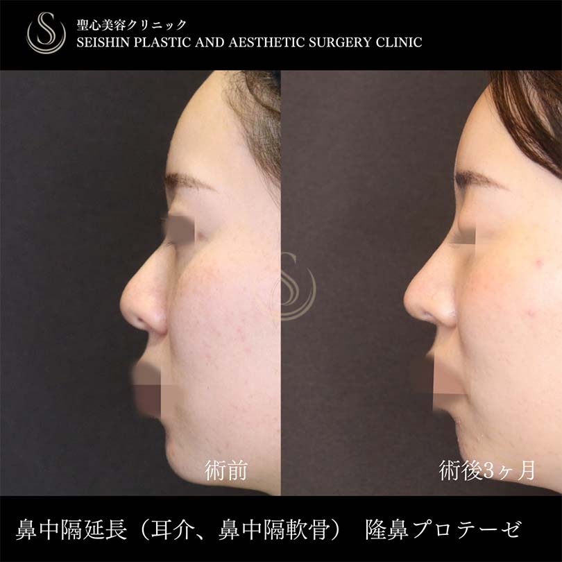 鼻中隔延長術＋プロテーゼによる隆鼻術＋鼻尖形成（耳介軟骨移植）_Before