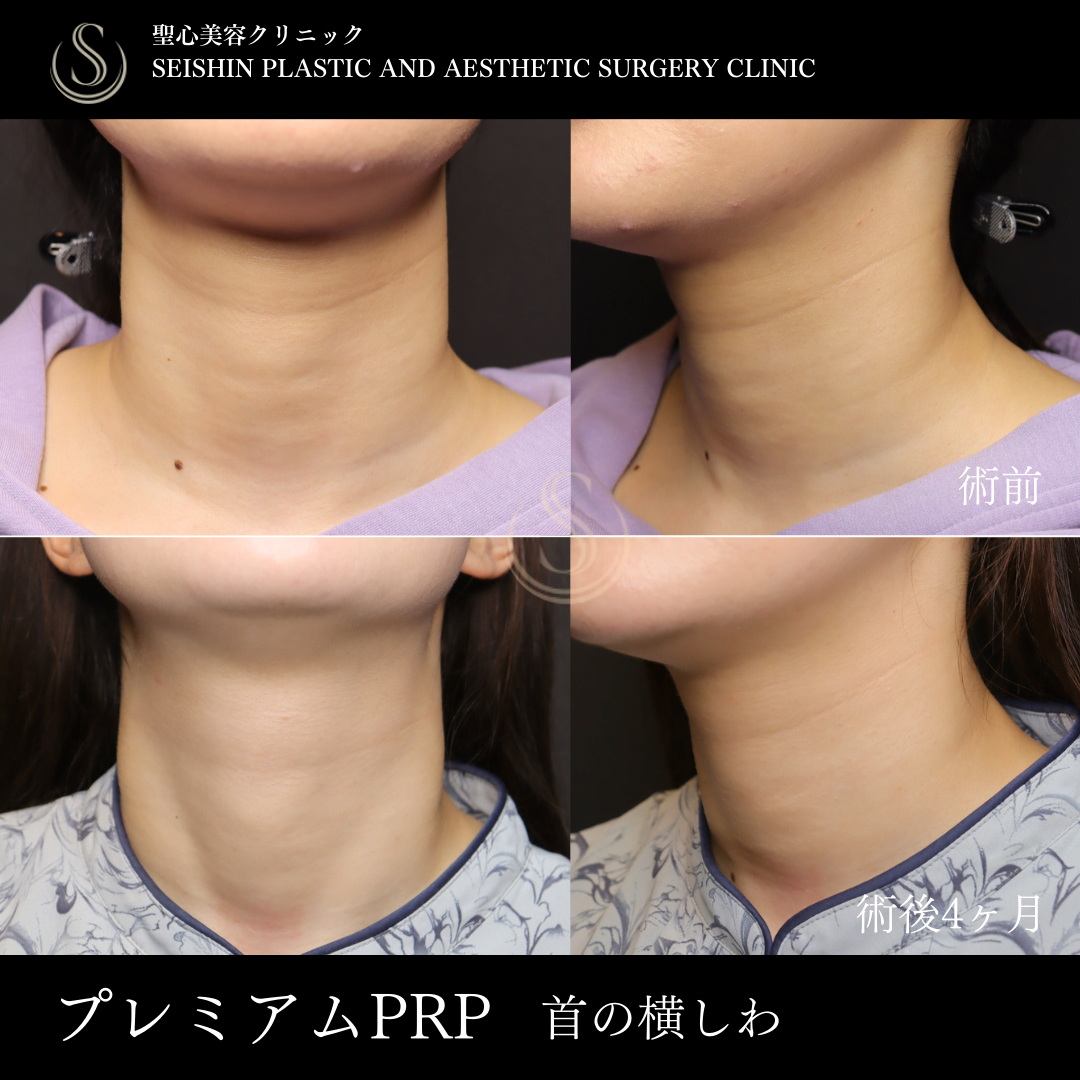 プレミアムPRP皮膚再生療法_Before