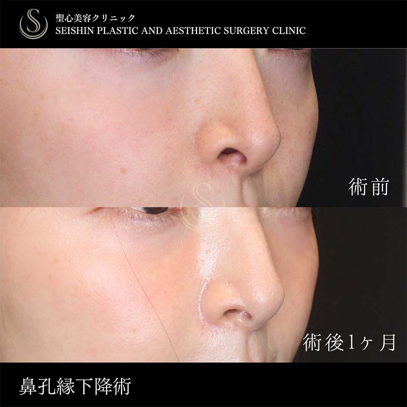 鼻孔縁下降術_Before