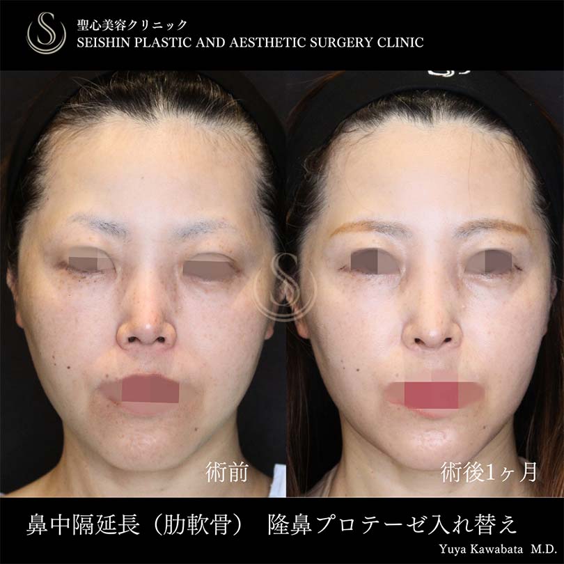 鼻中隔延長術＋鼻尖形成（耳介軟骨移植）＋プロテーゼによる隆鼻術_After