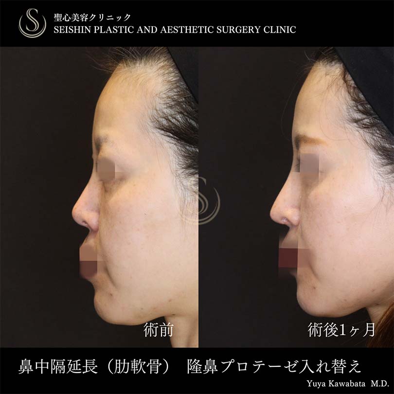 鼻中隔延長術＋鼻尖形成（耳介軟骨移植）＋プロテーゼによる隆鼻術_Before