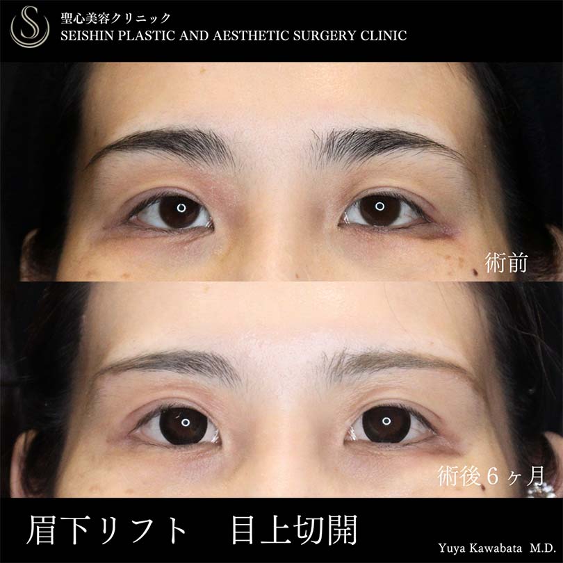眉下切開法（眉下リフト）＋目上切開_Before