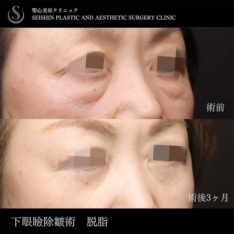 下眼瞼切開術/下眼瞼除皺術/ハムラ法_After