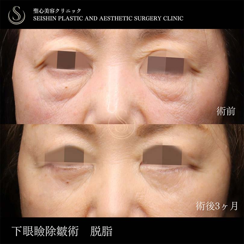下眼瞼切開術/下眼瞼除皺術/ハムラ法_Before