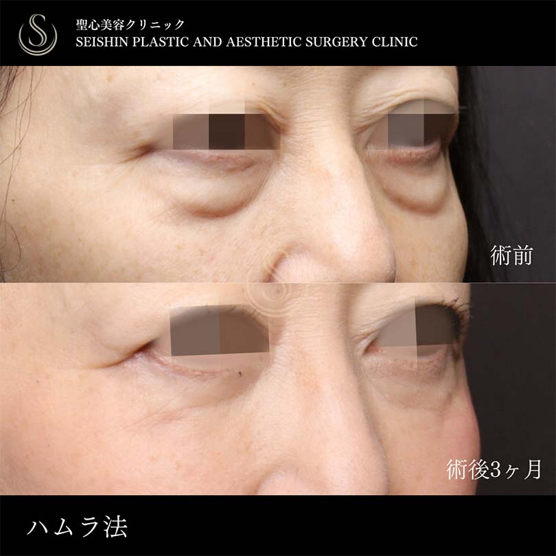 下眼瞼切開術/下眼瞼除皺術/ハムラ法_After