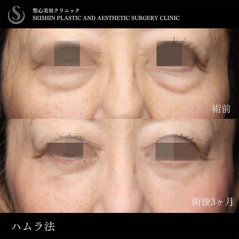 下眼瞼切開術/下眼瞼除皺術/ハムラ法_Before