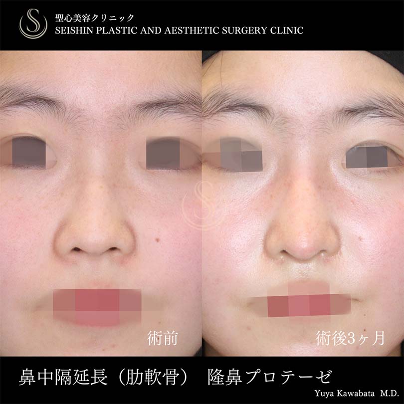 鼻中隔延長術＋鼻尖形成（耳介軟骨移植）＋プロテーゼによる隆鼻術_After