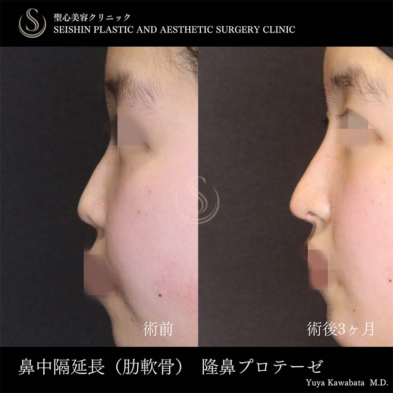 鼻中隔延長術＋鼻尖形成（耳介軟骨移植）＋プロテーゼによる隆鼻術_Before