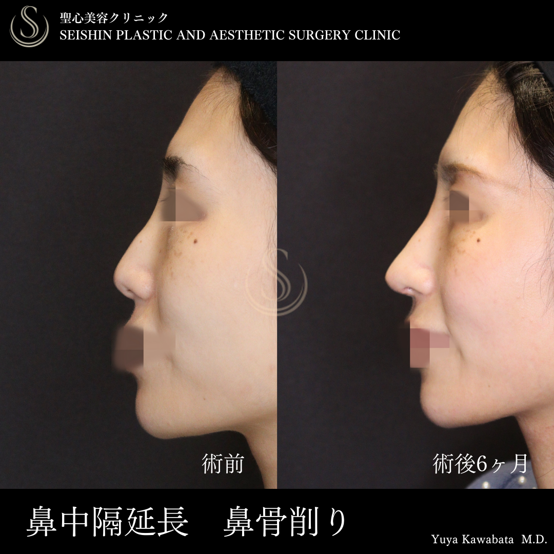 鼻中隔延長術＋鼻尖形成（耳介軟骨移植）＋鷲鼻修正（わし鼻修正、整鼻術・低鼻術）_Before