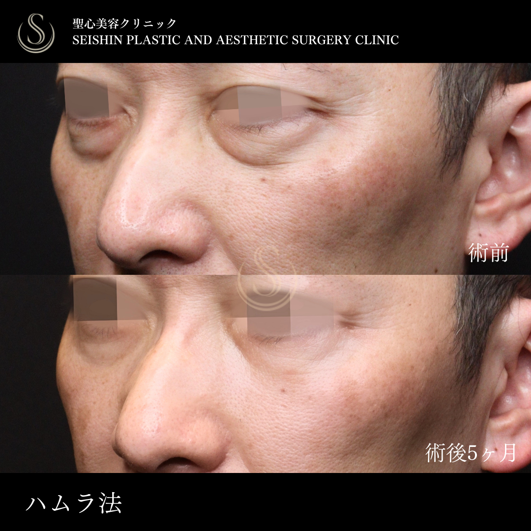 下眼瞼切開術/下眼瞼除皺術/ハムラ法_After