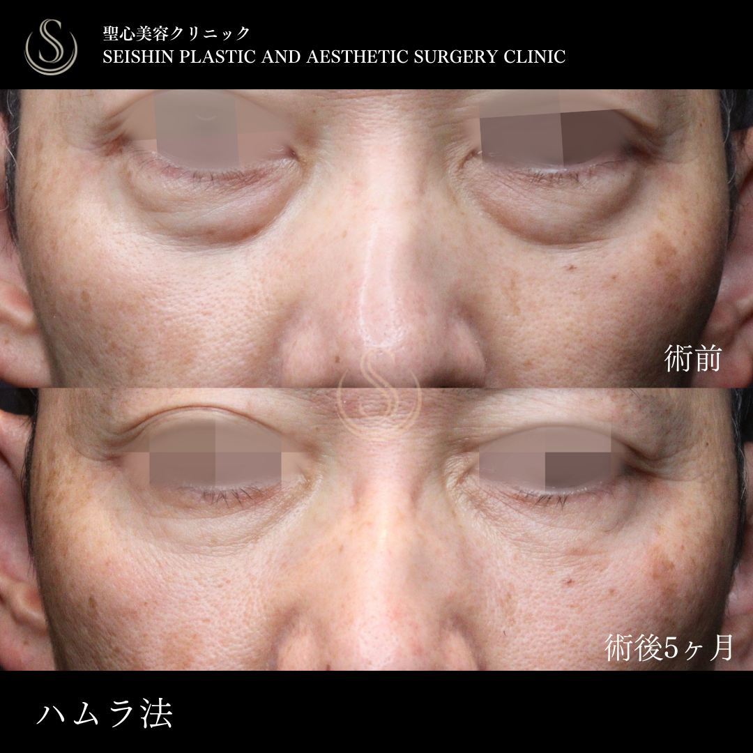下眼瞼切開術/下眼瞼除皺術/ハムラ法_Before