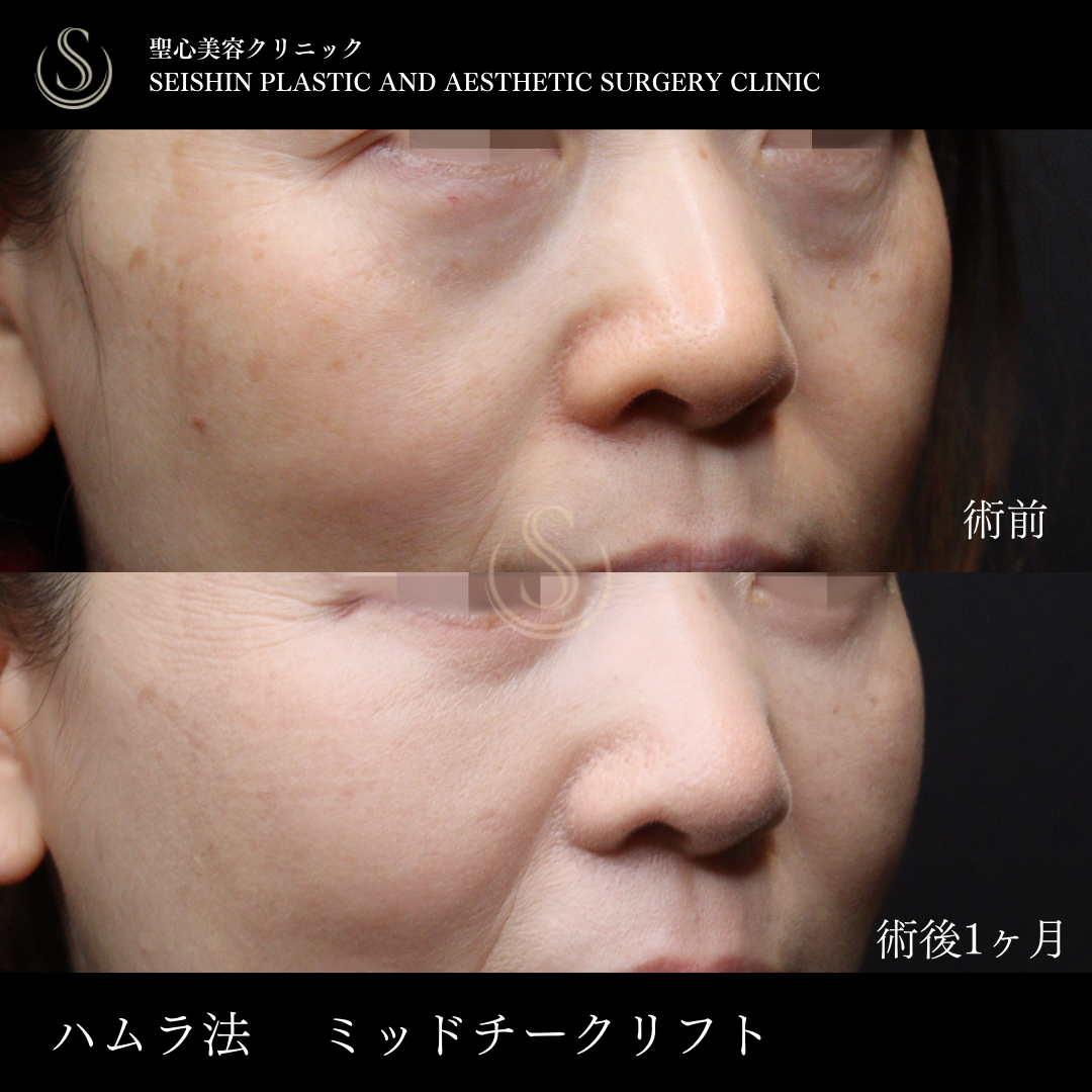 下眼瞼切開術/下眼瞼除皺術/ハムラ法_After