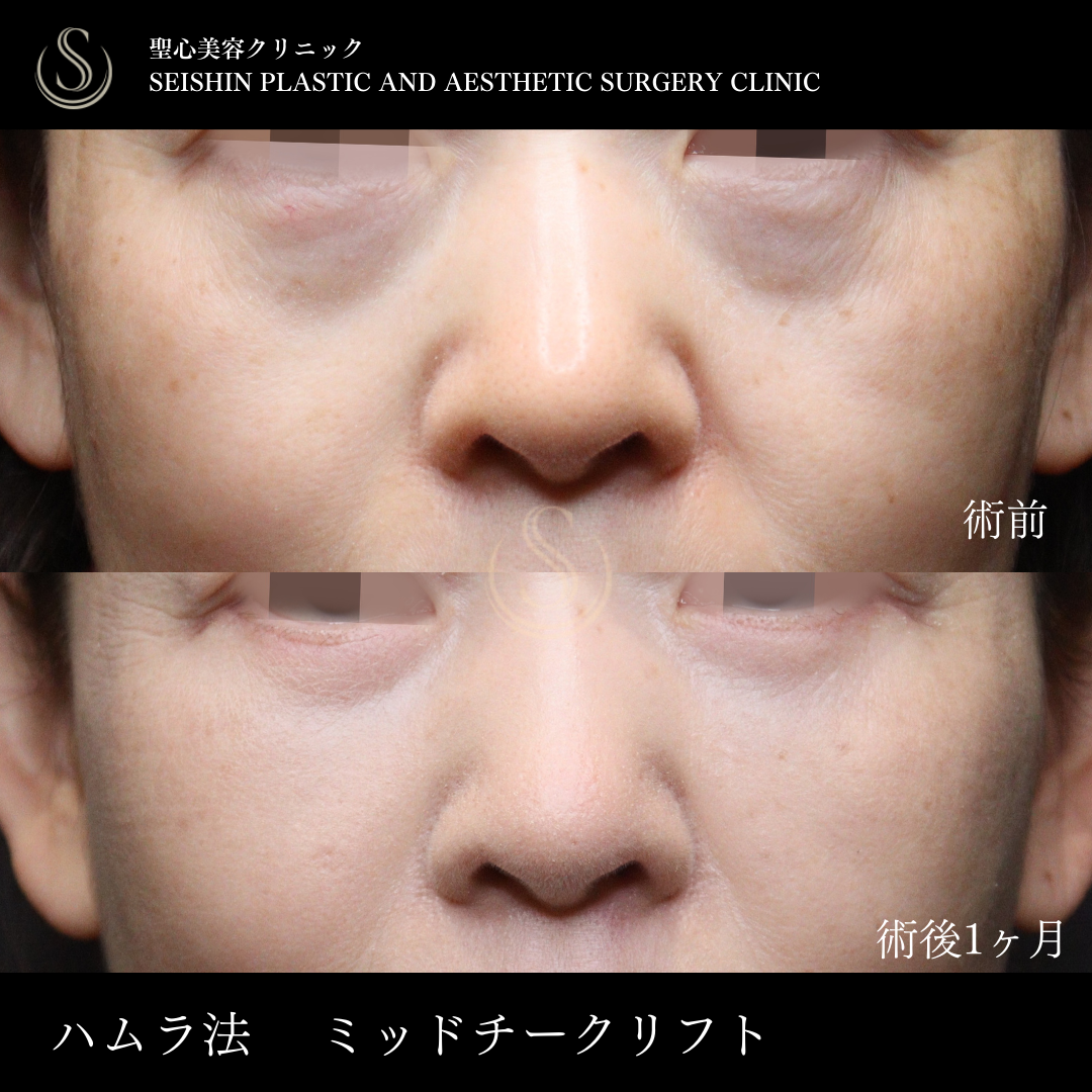 下眼瞼切開術/下眼瞼除皺術/ハムラ法_Before