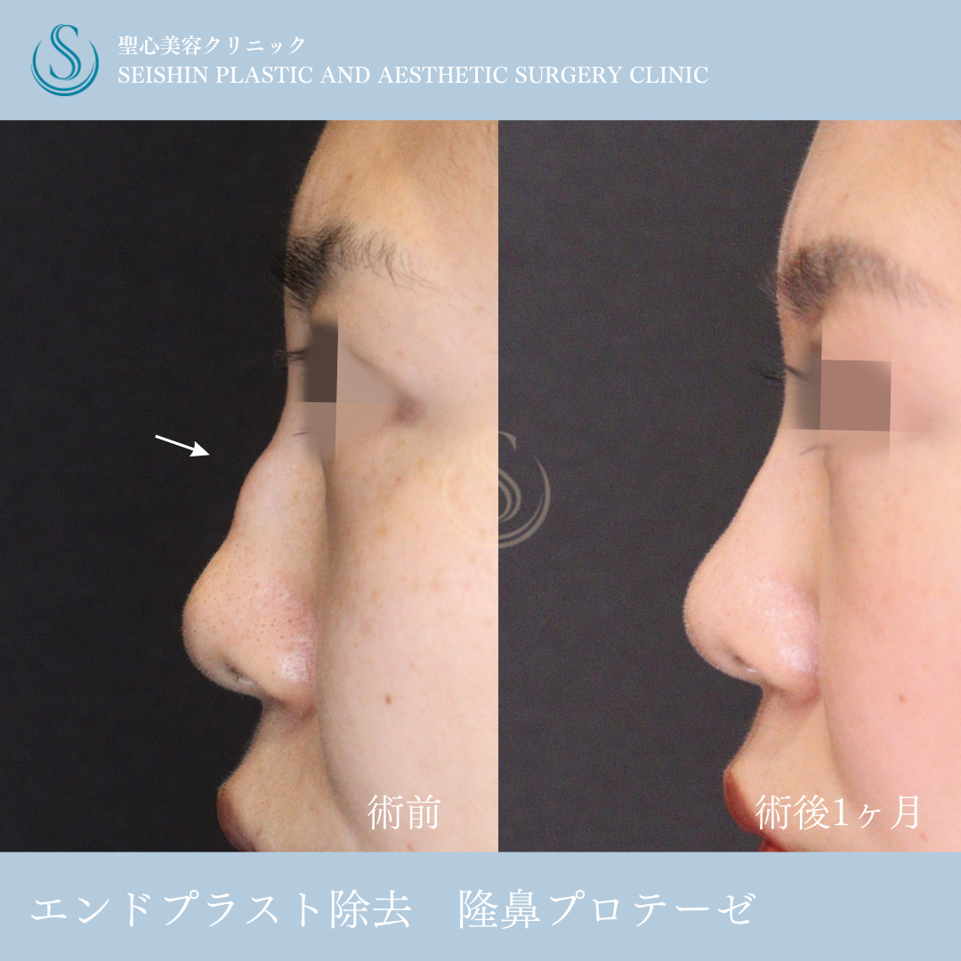 プロテーゼによる隆鼻術＋エンドプロテーゼ抜去_After